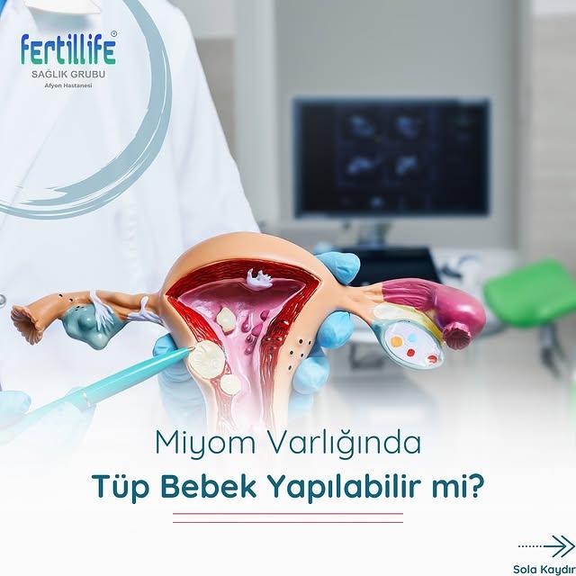 Miyomlu Hastalar İçin Tüp Bebek Umudu: Fertillife Afyon, Bilgilendirme Desteği Sunuyor